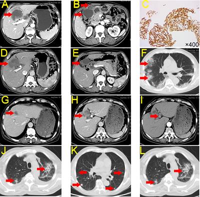 Case report: Preliminary response to tislelizumab plus S-1 in patients with metastatic gallbladder carcinoma: A report of five cases and a literature review